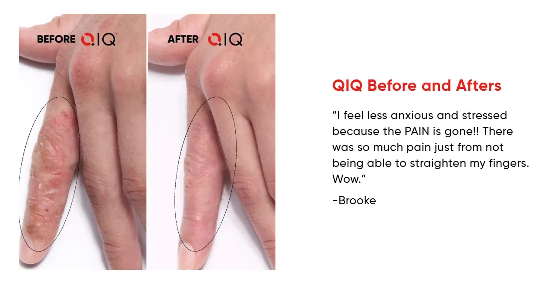 Before and after photo showing Brooke's hands
