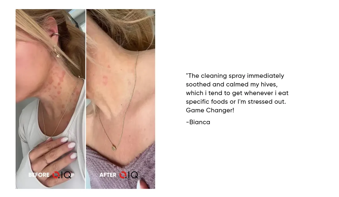 Before and after photo showing Bianca's skin on her neck and chest